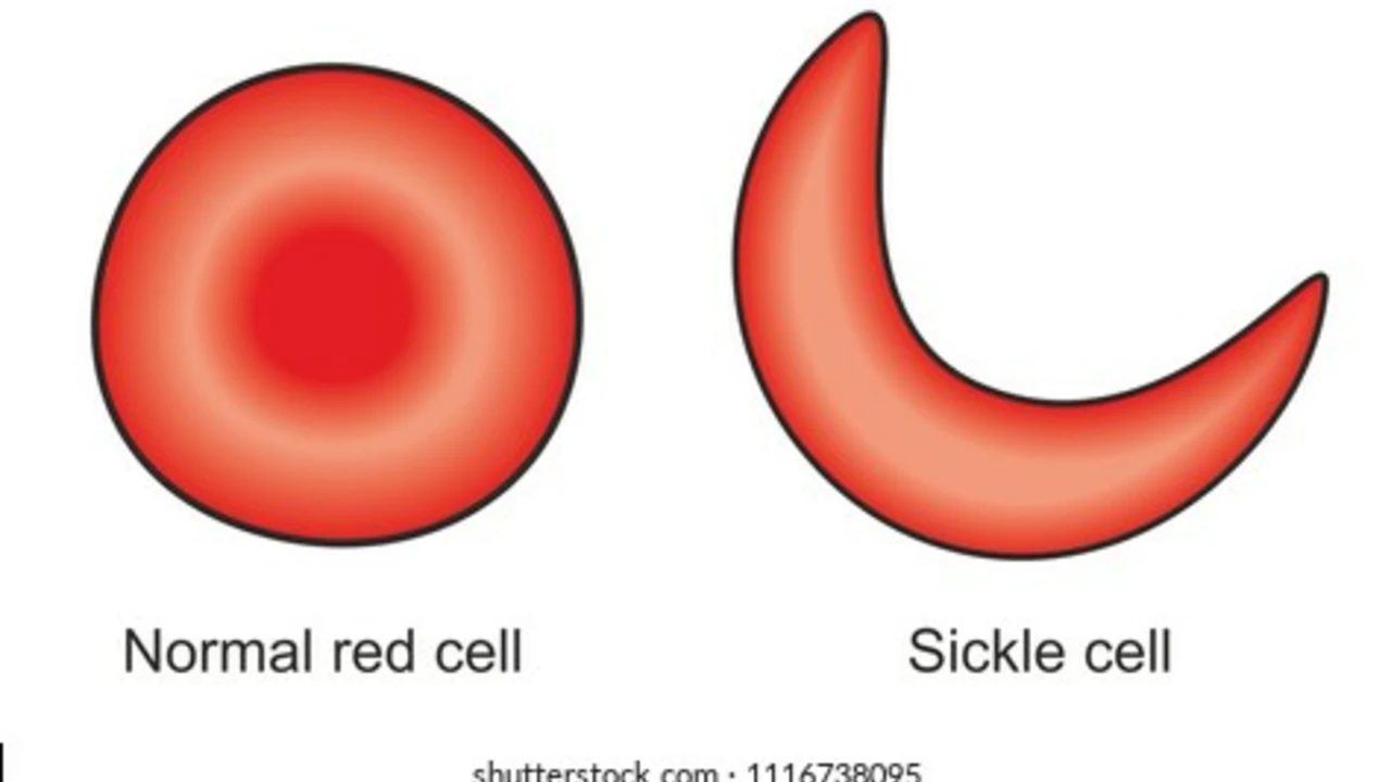 Living with Sickle Cell Anemia: Daily Challenges and Coping Strategies